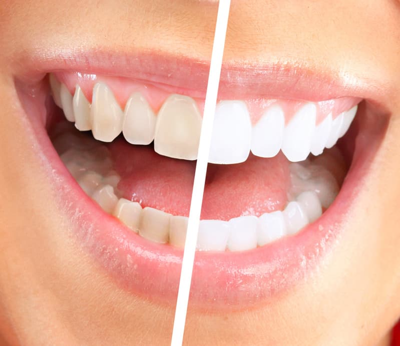 Gum Treatment In Gurgaon At Affordable Cost